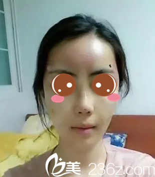 玻尿酸隆鼻+自體脂肪填充面部手術(shù)后當(dāng)天的樣子 玻尿酸隆鼻+自體脂肪填充面部手術(shù)后當(dāng)天的樣子