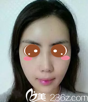 做玻尿酸隆鼻+自體脂肪填充面部術(shù)后兩周 做玻尿酸隆鼻+自體脂肪填充面部術(shù)后兩周