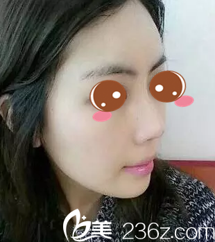 一起見證我在懷化華美整形醫(yī)院做玻尿酸隆鼻+自體脂肪填充面部兩周后神奇蛻變