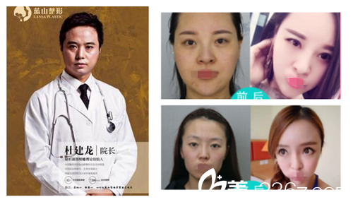 杜建龍院長自體脂肪填充案例