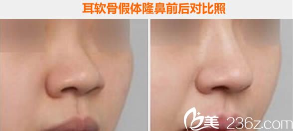 蘭州夢想耳軟骨假體隆鼻前后對比<span style= 蘭州夢想耳軟骨假體隆鼻前后對比<span style=