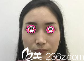 在北京華韓做面部吸脂前樣子 在北京華韓做面部吸脂前樣子