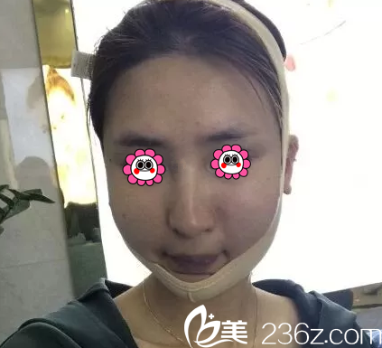 在北京華韓做面部吸脂第4天 在北京華韓做面部吸脂第4天