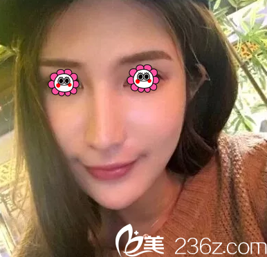 北京華韓余恩旭給我做面部吸脂8天 北京華韓余恩旭給我做面部吸脂8天