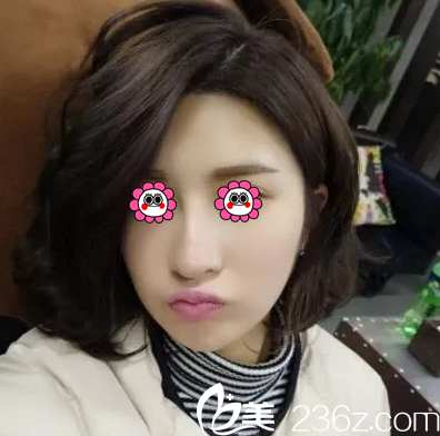 北京華韓面部吸脂 北京華韓面部吸脂