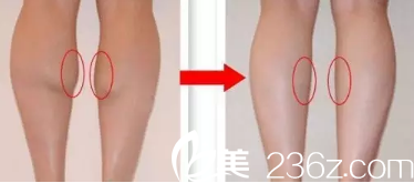 瘦臉除皺注射瘦腿案例