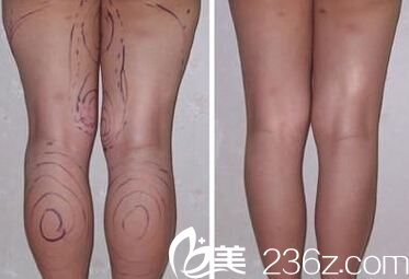 激光溶脂瘦腿案例