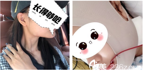 在深圳非凡找羅奇做下頜角手術(shù)前 在深圳非凡找羅奇做下頜角手術(shù)前