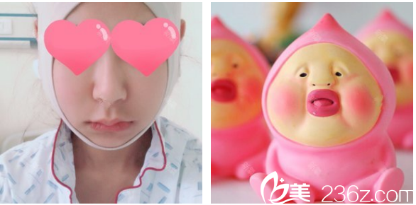 整形醫(yī)生羅奇博士做的下頜角術(shù)后第二天 整形醫(yī)生羅奇博士做的下頜角術(shù)后第二天