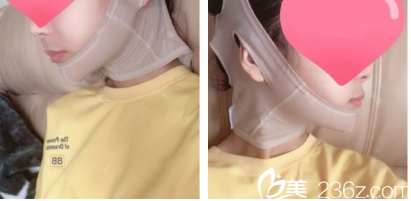 下頜角磨骨七天拆線效果圖 下頜角磨骨七天拆線效果圖