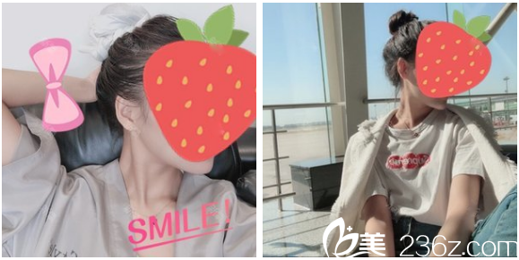 深圳非凡羅奇博士做的下頜角磨骨真人案例 深圳非凡羅奇博士做的下頜角磨骨真人案例