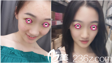 北京華韓邢志花微針案例 北京華韓邢志花微針案例