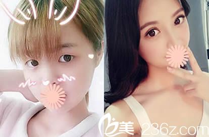 福州名韓林峰個人案例雙眼皮前后對比圖