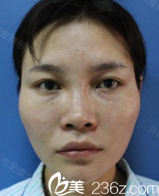 沒有在合肥壹加壹做肋軟骨鼻綜合隆鼻前樣子 沒有在合肥壹加壹做肋軟骨鼻綜合隆鼻前樣子