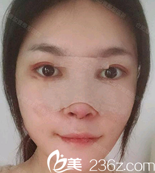 找合肥壹加壹甘泉涌做肋軟骨鼻綜合術(shù)后第1天照片 找合肥壹加壹甘泉涌做肋軟骨鼻綜合術(shù)后第1天照片