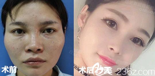 肋軟骨隆鼻+玻尿酸填充太陽穴前后效果對比圖 肋軟骨隆鼻+玻尿酸填充太陽穴前后效果對比圖