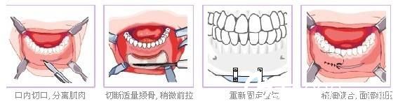 假體墊下巴手術(shù)原理