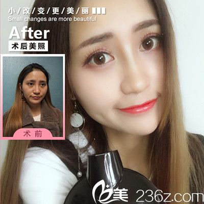 廣州華美注射雙美膠原蛋白真人案例