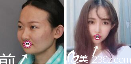 貴州利美康田士云打玻尿酸效果怎么樣 貴州利美康田士云打玻尿酸效果怎么樣