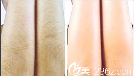激光脫毛手術(shù)前后對比效果 激光脫毛手術(shù)前后對比效果