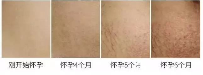 懷孕期間很容易出現(xiàn)妊娠紋