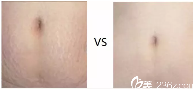 妊娠紋去除前后對比案例