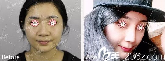 重慶時(shí)光陳玉連假體隆鼻案例