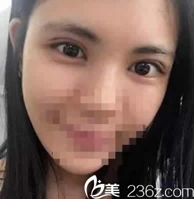 80后寶媽分享找太原華美整形做全切雙眼皮+開眼角一個月恢復過程圖