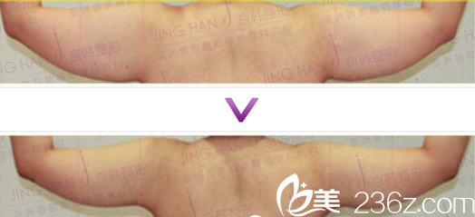 北京京韓喬愛軍大臂吸脂案例