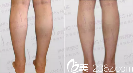 北京京韓喬愛軍小腿吸脂案例