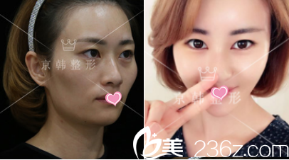 北京京韓喬愛(ài)軍面部脂肪填充案例 北京京韓喬愛(ài)軍面部脂肪填充案例