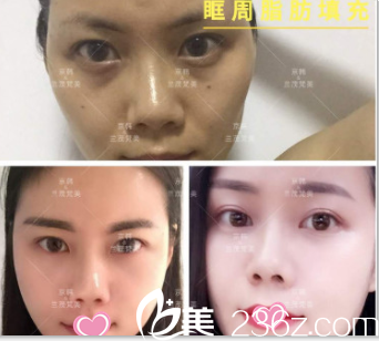 北京京韓喬愛(ài)軍眶周脂肪填充案例 北京京韓喬愛(ài)軍眶周脂肪填充案例