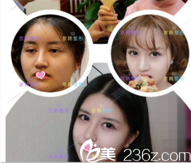 北京京韓張振眼修復(fù)案例 北京京韓張振眼修復(fù)案例