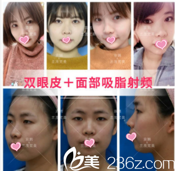 北京京韓張振雙眼皮+面部吸脂射頻案例 北京京韓張振雙眼皮+面部吸脂射頻案例
