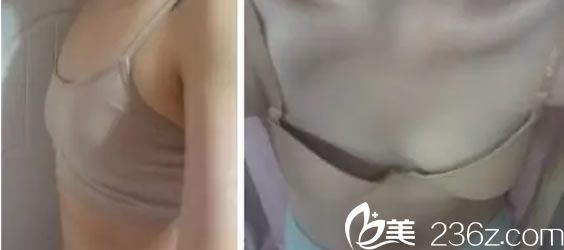 韓國來福琳整形隆胸手術(shù)前 韓國來福琳整形隆胸手術(shù)前