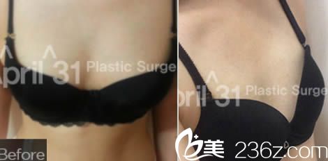 韓國4月31日整形外科隆胸術(shù)前照 韓國4月31日整形外科隆胸術(shù)前照