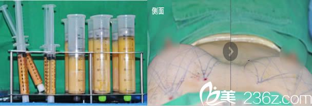 韓國4月31日整形外科自體脂肪隆胸術(shù)后即刻照 韓國4月31日整形外科自體脂肪隆胸術(shù)后即刻照