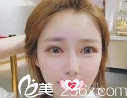 恢復(fù)18天的雙眼皮已經(jīng)消腫 恢復(fù)18天的雙眼皮已經(jīng)消腫