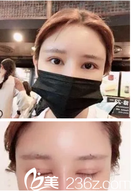 切開雙眼皮術(shù)后7天拆線后眼睛微腫 切開雙眼皮術(shù)后7天拆線后眼睛微腫