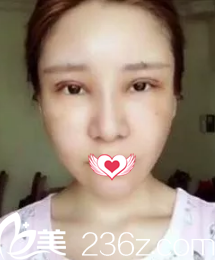 術(shù)后第二天眼睛腫脹 術(shù)后第二天眼睛腫脹