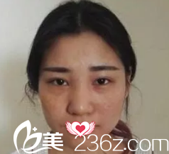 術(shù)前雙眼皮失敗導(dǎo)致兩邊不對稱 術(shù)前雙眼皮失敗導(dǎo)致兩邊不對稱
