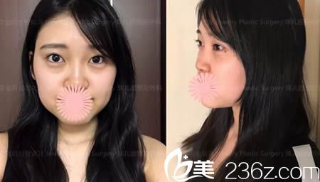 韓國珠兒麗整形外科的術(shù)前照 韓國珠兒麗整形外科的術(shù)前照