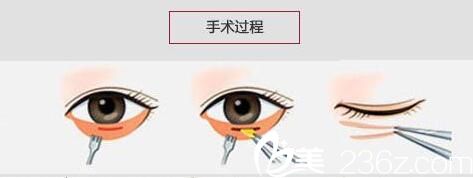 眼袋抽脂手術(shù)過程