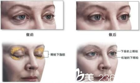 眼袋抽脂價(jià)格受四大因素影響1
