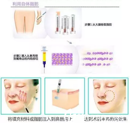 自體脂肪填充法令紋