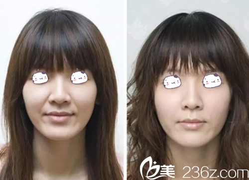 自體脂肪填充法令紋案例