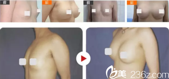 閔度源隆胸案例 閔度源隆胸案例