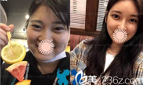 做雙眼皮+顴骨縮小術(shù)+下巴整形手術(shù)后和術(shù)前的對比照 做雙眼皮+顴骨縮小術(shù)+下巴整形手術(shù)后和術(shù)前的對比照