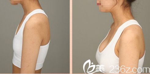 劉健做豐胸案例