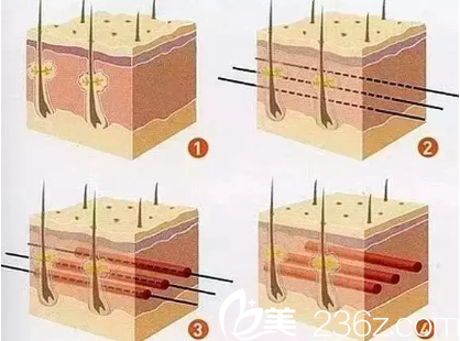 <!--<i data=20240703-sp></i>-->三維分區(qū)復(fù)位線雕術(shù) <!--<i data=20240703-sp></i>-->三維分區(qū)復(fù)位線雕術(shù)